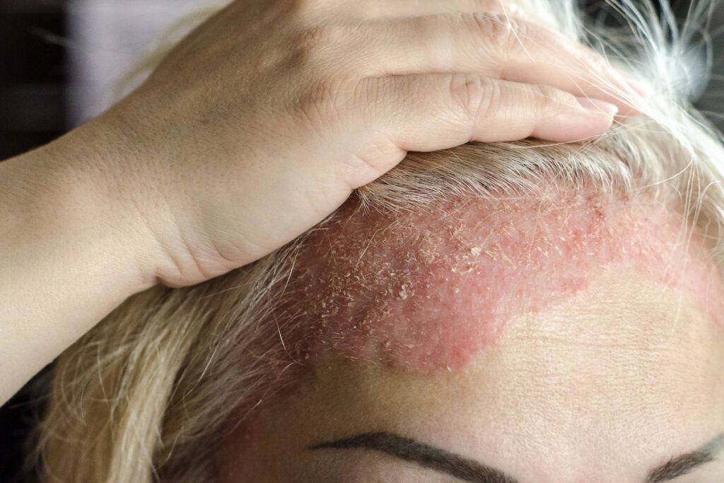 best eczema treatment