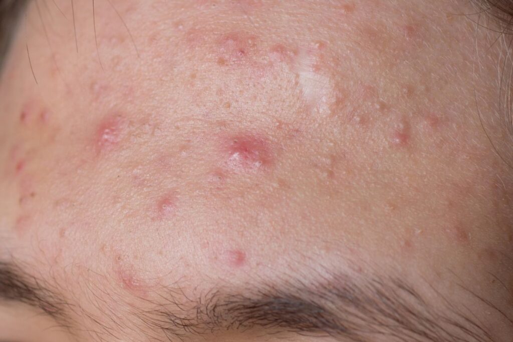 best treatment for fungal acne